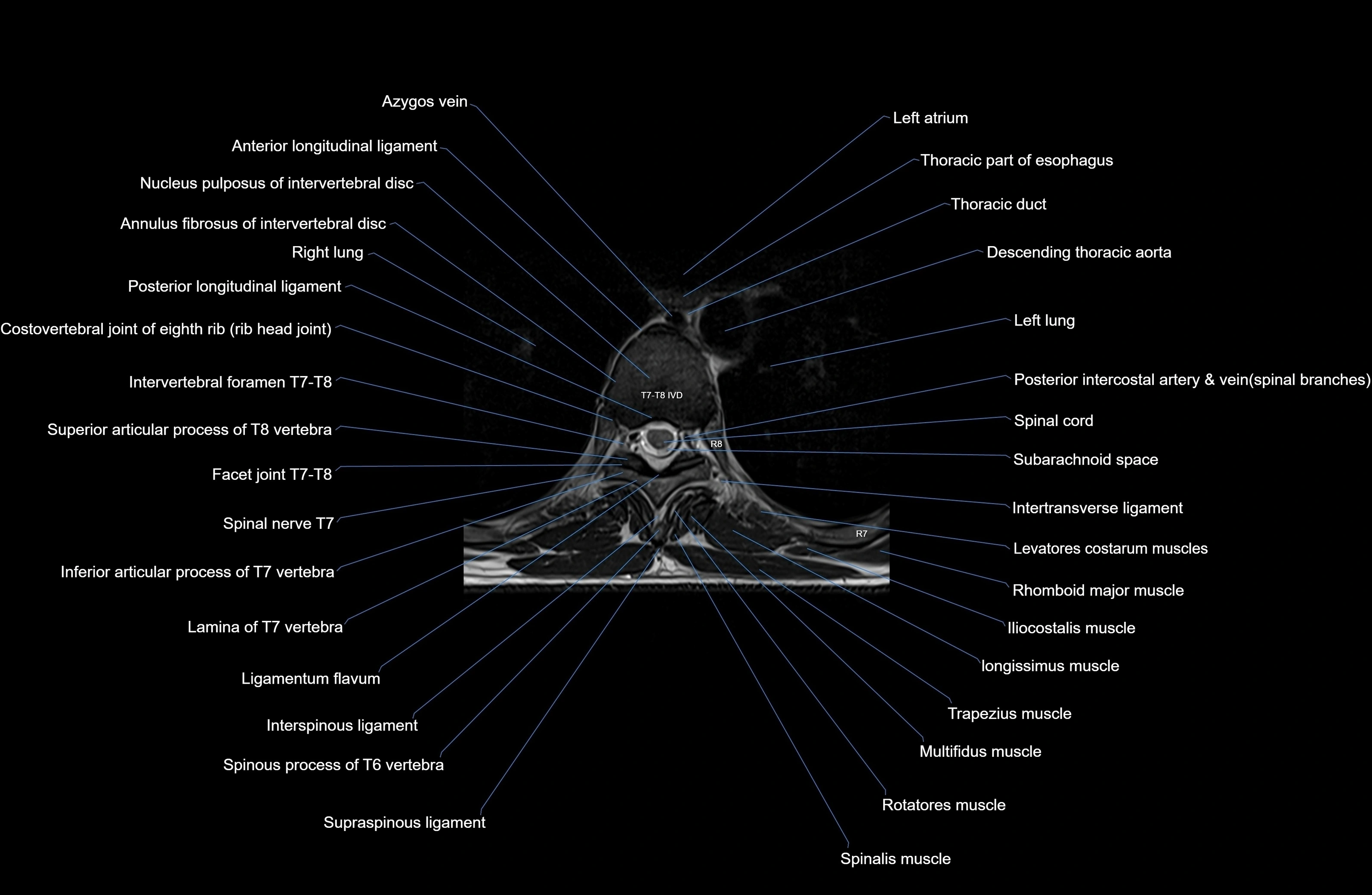 MRI thoracic spine axial  cross sectional anatomy 3T radiology  image-img-00001-00049.webp